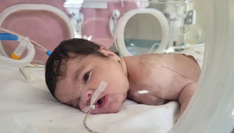 34 Haftalık Eymen Bebek'ten Umut Verici Gelişme: Dünyada 7. Vaka!