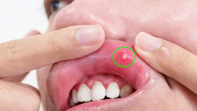 Dil Kanseri Belirtilerini Göz Ardı Eden Adam, Hayatıyla Flaş Bir Karar Aldı!